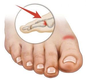 9 boli care provoacă durerea la degetul mare de la picior
